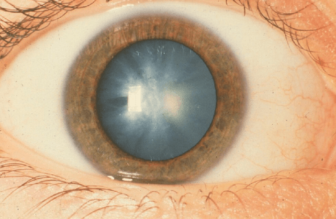 Cataracts - Symptoms