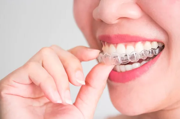 Invisalign treatment