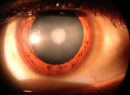 Cataracts - Symptoms and causes