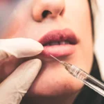 Why Melbourne Is The Ideal Destination For Lip Fillers