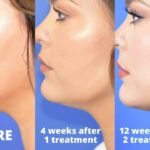 4 Reasons Why Chin Coolsculpting Is Becoming More Popular