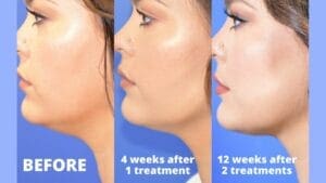 CoolSculpting Chin